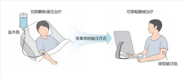 浙大团队发明贴敷式输注贴